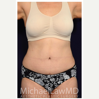 45-54 year old woman treated with Tummy Tuck after 3070910