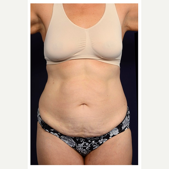 45-54 year old woman treated with Tummy Tuck before 3070910