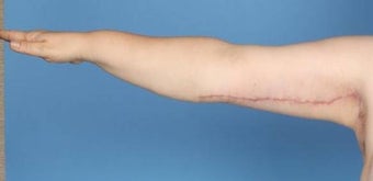 Brachioplasty 841609