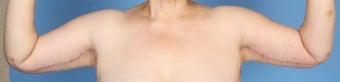 Brachioplasty after 841609