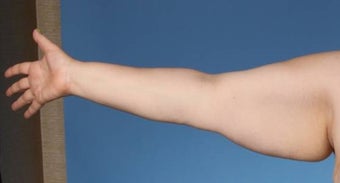 Brachioplasty 841609