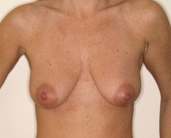 Augmentation with mastopexy before 331363