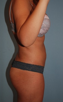 Smart Lipo after 1409630