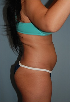 Smart Lipo before 1409630