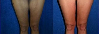 Thigh Lift after massive weight loss before 667116