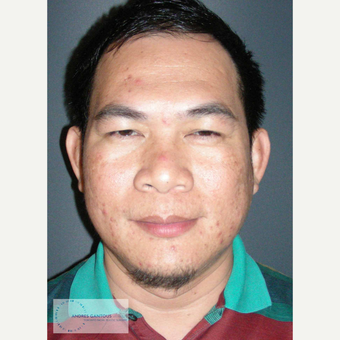 35-44 year old man treated with Rhinoplasty before 3692050
