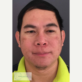 35-44 year old man treated with Rhinoplasty after 3692050