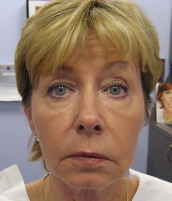 Full face rejuvenation with Botox, dermal fillers and laser after 1328588