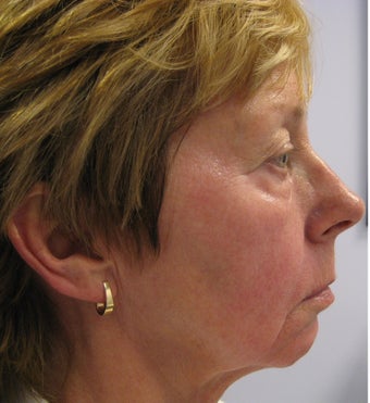 Full face rejuvenation with Botox, dermal fillers and laser 1328588