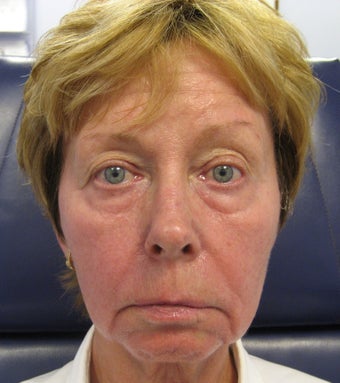 Full face rejuvenation with Botox, dermal fillers and laser before 1328588