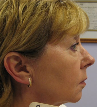 Full face rejuvenation with Botox, dermal fillers and laser 1328588