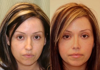 Natural Rhinoplasty before 251847