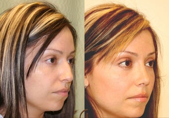 Natural Rhinoplasty after 251847