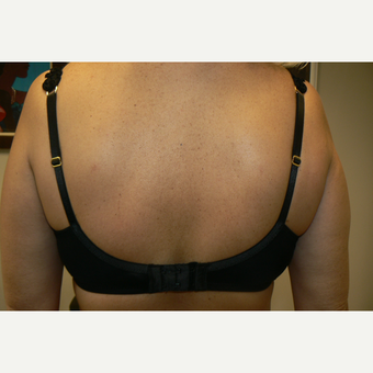 45-54 year old woman treated with Exilis after 3528660