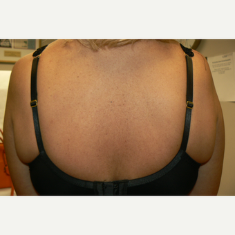 45-54 year old woman treated with Exilis before 3528660
