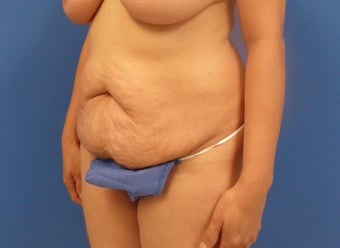 44 y.o. female–Mommy Makeover, Breast Lift w/ Silicone Style 15 421cc & Abdominoplasty (Tummy Tuck) before 3089178