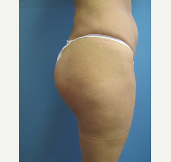 25-34 year old woman treated with Butt Lift after 3762716
