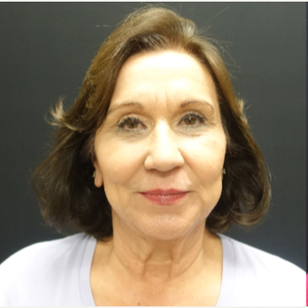 65-74 year old woman treated with SMAS Facelift before 3244954