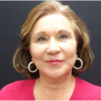 65-74 year old woman treated with SMAS Facelift after 3244954