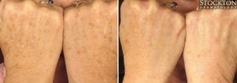 55-64 year old woman treated with Photofacial for hands before 2094249