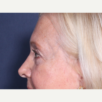 65-74 year old woman treated with Eyelid Surgery (view 2 of 2) after 3709331