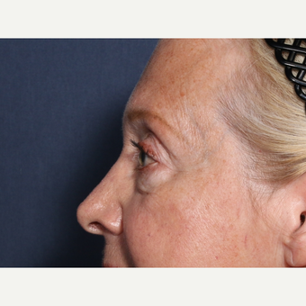 65-74 year old woman treated with Eyelid Surgery (view 2 of 2) before 3709331