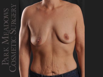 Silicone Breast Augmentation using Dual Plane Technique; 450 cc Silicone Implants before 1034767