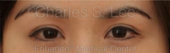 Asian Eyelid Surgery after 815801