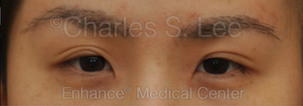 Asian Eyelid Surgery before 815801