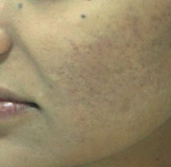 25-34 year old woman treated with Derma Roller after 1789340