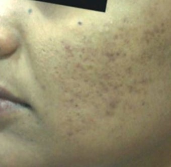 25-34 year old woman treated with Derma Roller before 1789340