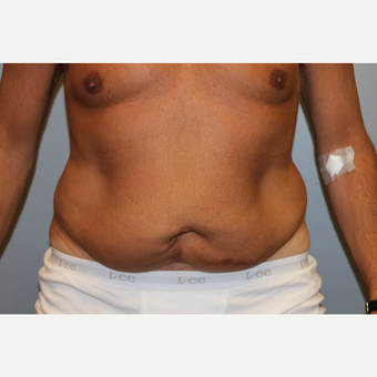 55-64 year old man treated with Tummy Tuck before 3529020