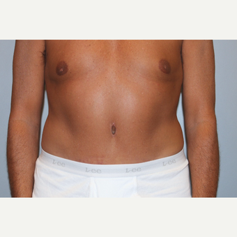 55-64 year old man treated with Tummy Tuck after 3529020