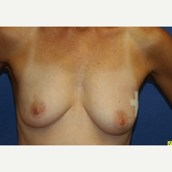 60 year old woman treated Fat Transfer breast augmentation before 3702525