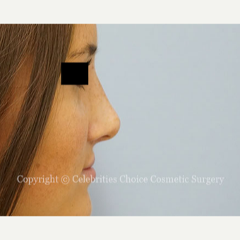 18-24 year old woman treated with Rhinoplasty after 3337780