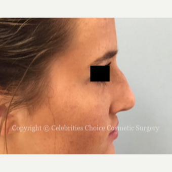 18-24 year old woman treated with Rhinoplasty before 3337780