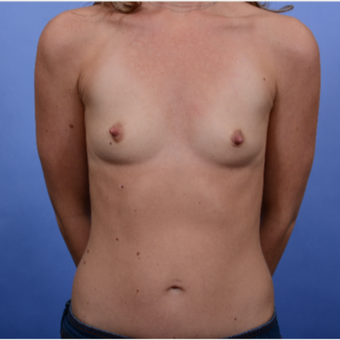 30 year old mother of 2 with Inspira SRF 370 submuscular breast implants before 3052082