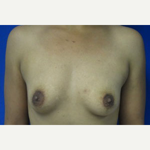 Breast Augmentation before 3054932