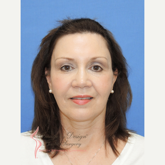 55-64 year old woman treated with Forehead Lift after 3159876