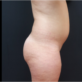 18-24 year old woman treated with Brazilian Butt Lift before 3315469