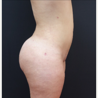 18-24 year old woman treated with Brazilian Butt Lift after 3315469