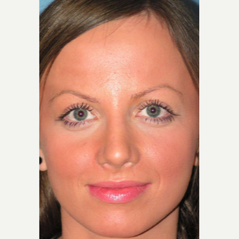 25-34 year old woman treated with Rhinoplasty after 3499837