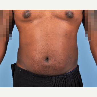 25-34 year old man treated with Liposuction after 3810091