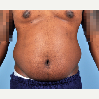 25-34 year old man treated with Liposuction before 3810091