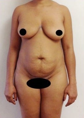25-34 year old woman treated with Tummy Tuck before 1806722