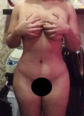 25-34 year old woman treated with Tummy Tuck after 1806722