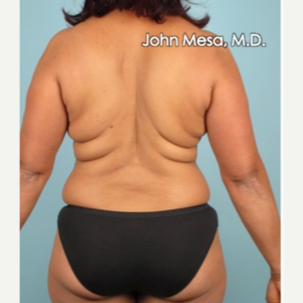 35-44 year old woman treated with Liposuction of flanks, back and sacrum before 3659831