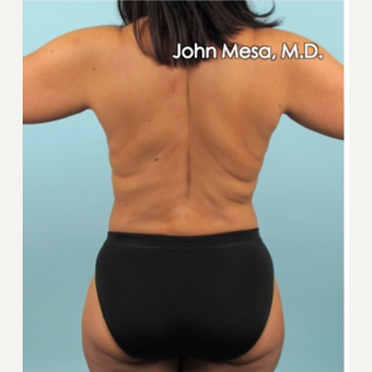 35-44 year old woman treated with Liposuction of flanks, back and sacrum after 3659831