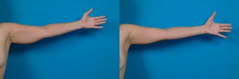 32-year-old woman treated with Liposuction. after 3287423