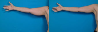 32-year-old woman treated with Liposuction. before 3287423